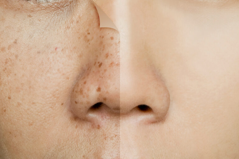 Read more about the article What’s the best way for age spots removal ?