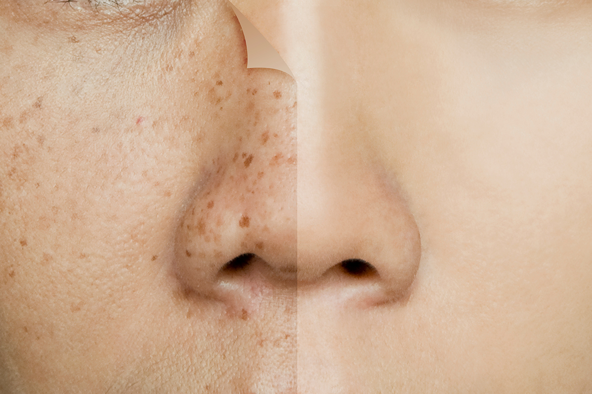 You are currently viewing What’s the best way for age spots removal ?