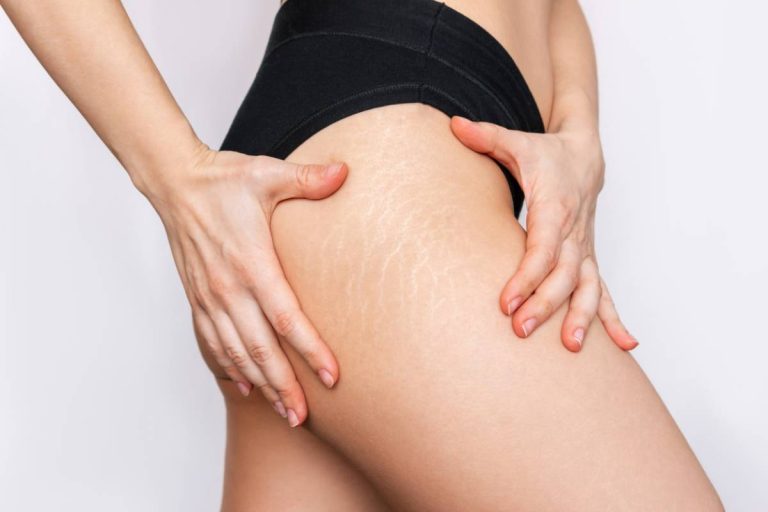 Read more about the article Why Do Stretch Marks Appear?